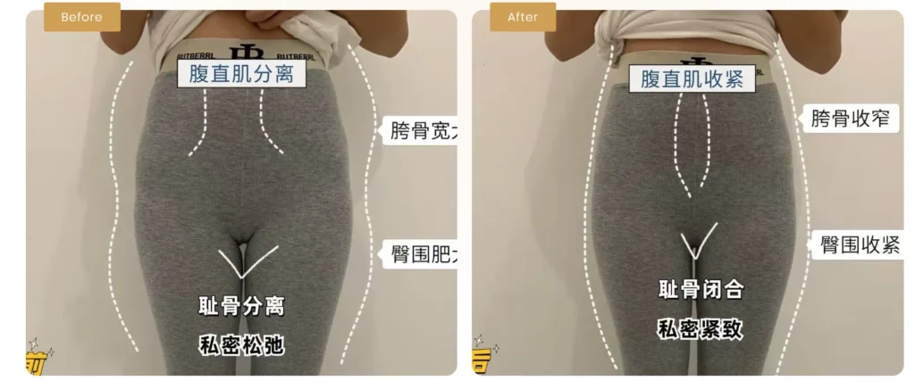 Real Results of Free Skin & Body Perfect’s Recovery Treatment for Wider Postpartum Hips