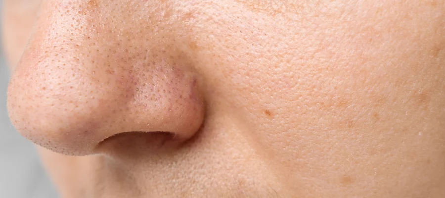  a close up shot of a face with enlarged pores