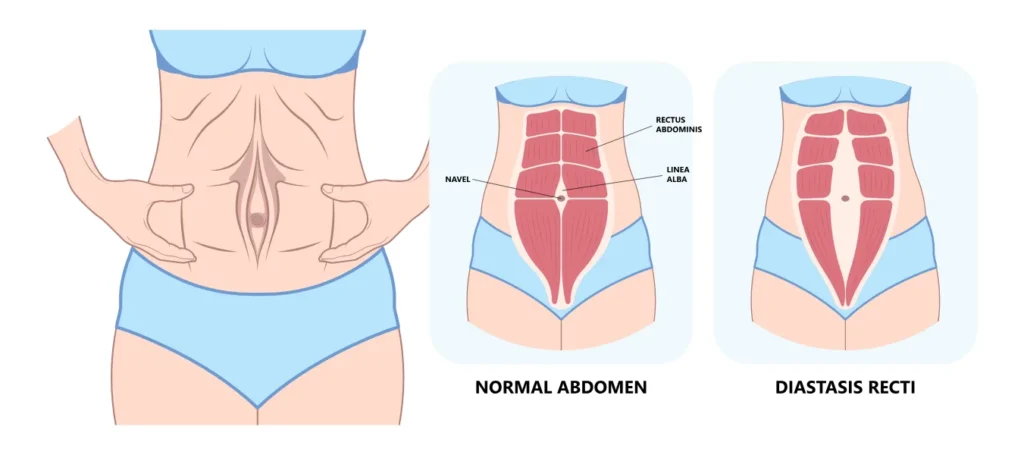 an illustration of normal abdomen vs diastasis recti